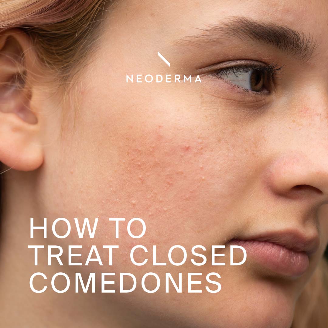 How to Treat Closed Comedones?