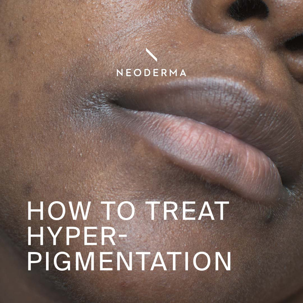 How to Treat Hyperpigmentation