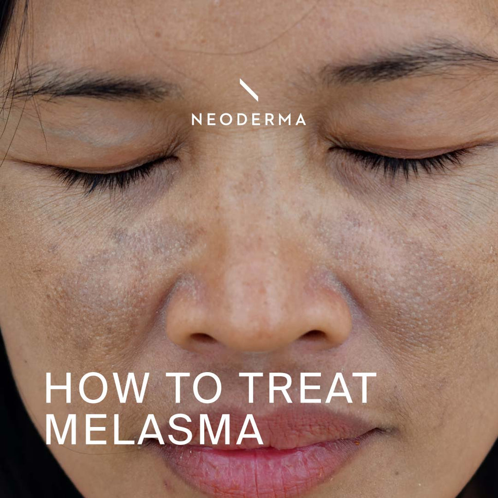 How to Treat Melasma