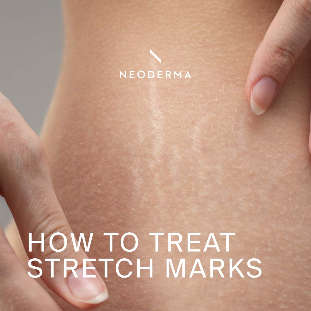 Erasing Marks Erasing Stretch Marks | Broad-Spectrum Sunscreen | Skincare Routine ...