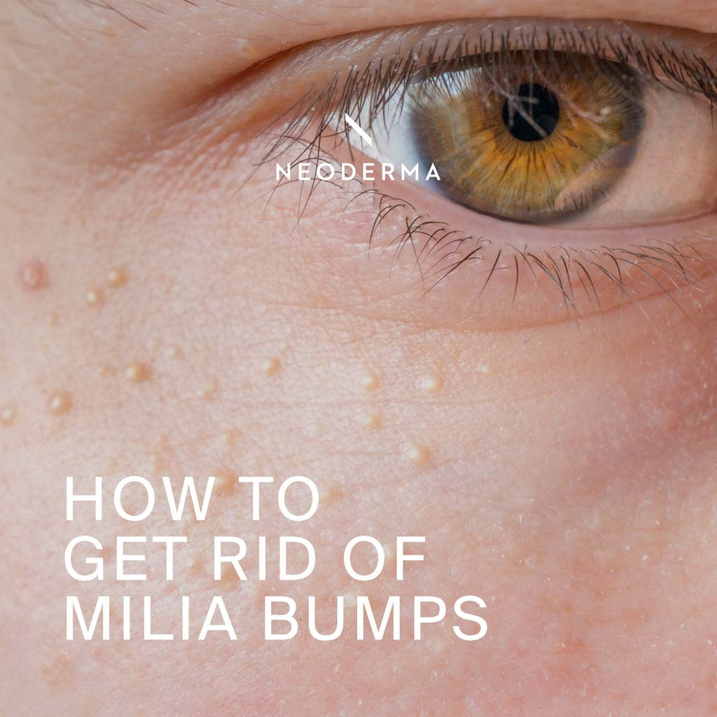 How to Get Rid of Milia Bumps