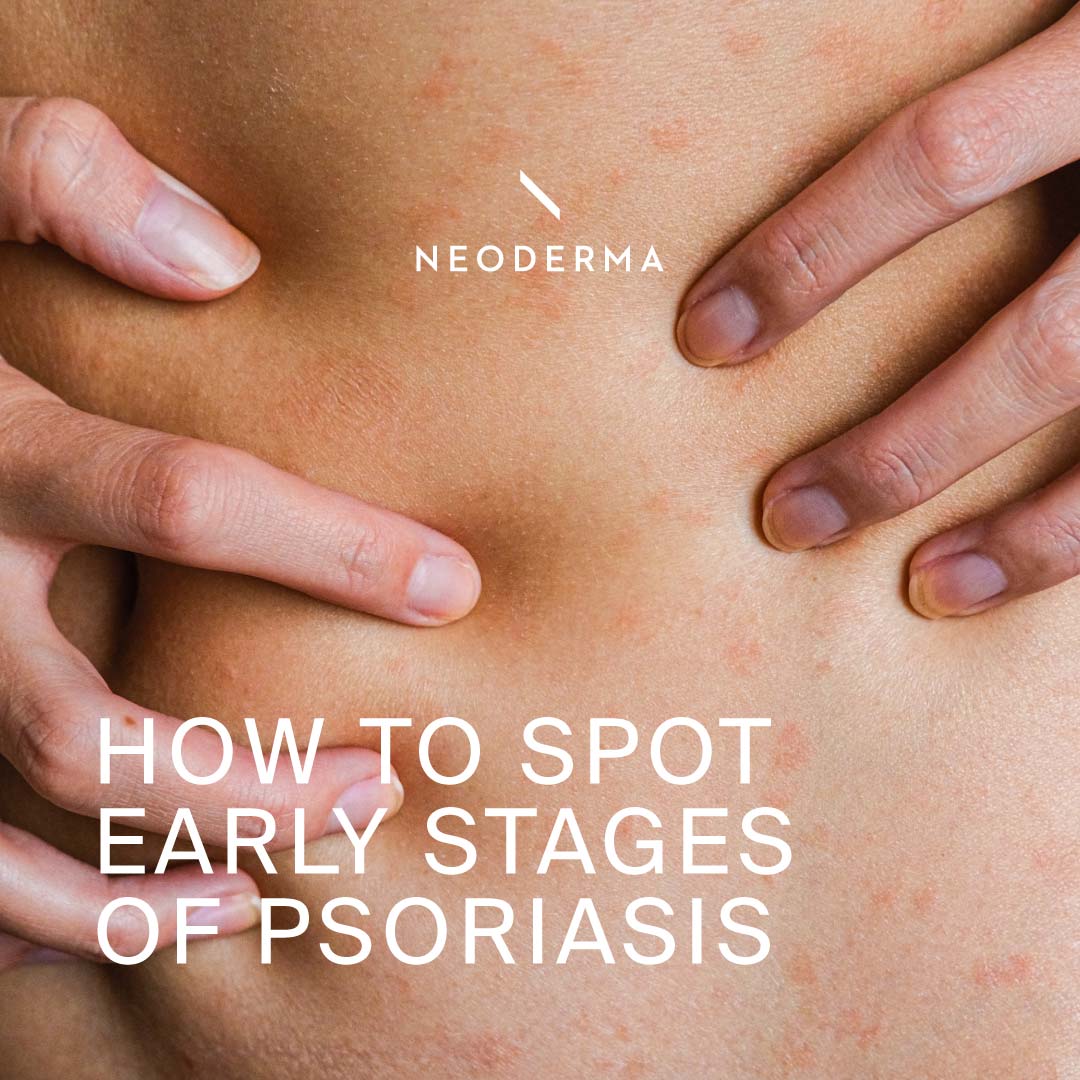 How to Spot Early Stages of Psoriasis?
