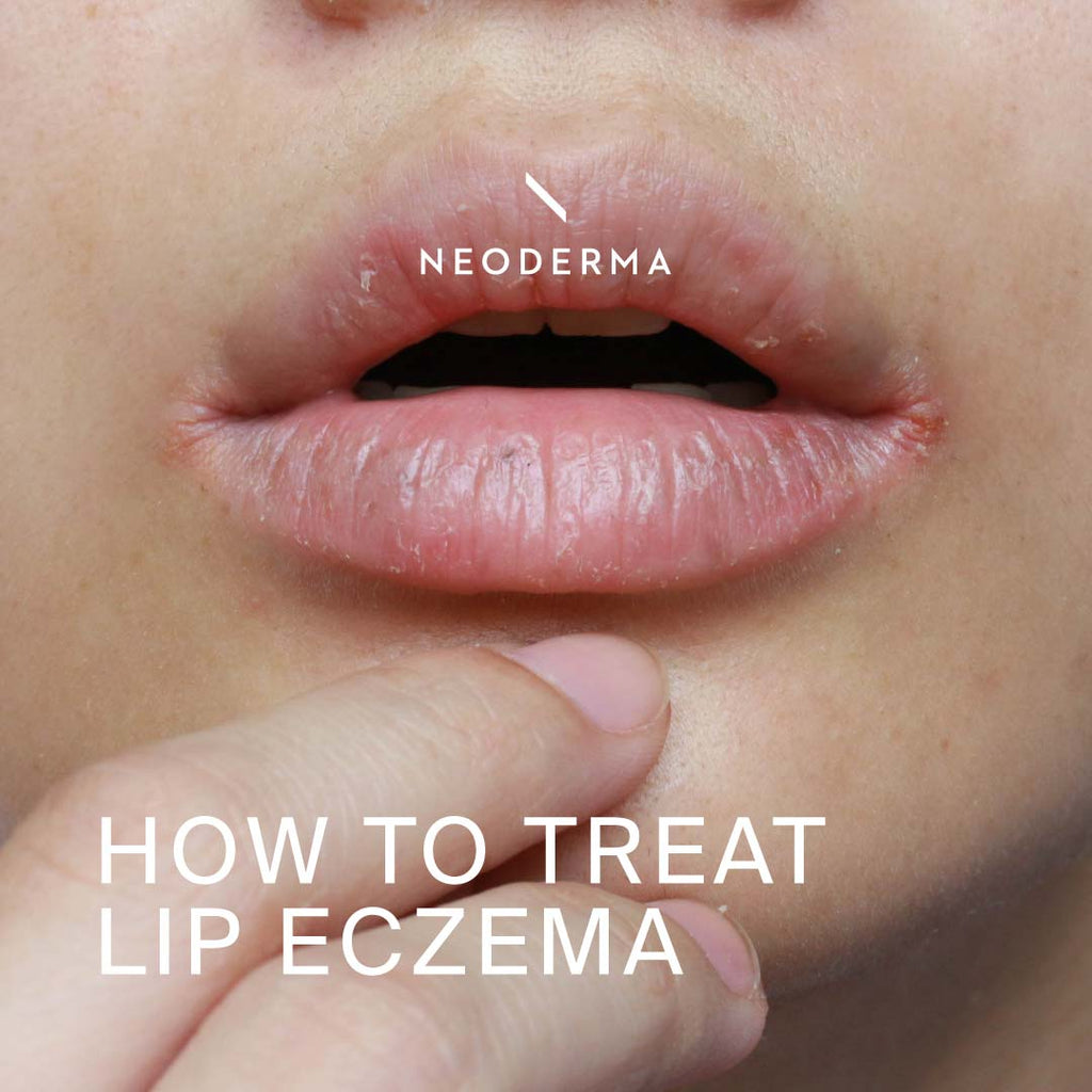 How to Treat Lip Eczema