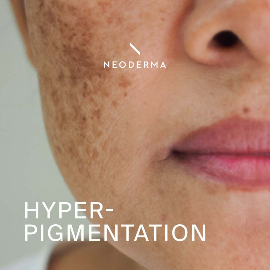 Hyperpigmentation