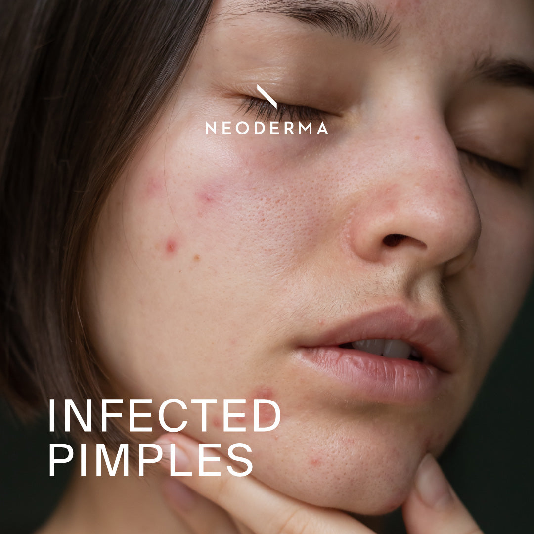 Exploding Infected Pimples Infected Pimple Treatment and Infected Pore on Face | NEODERMA