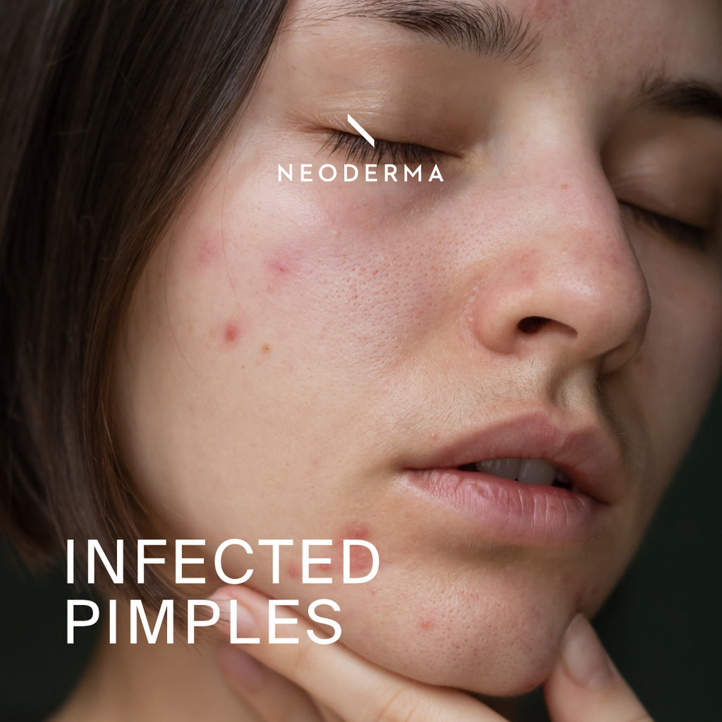 Infected Pimples