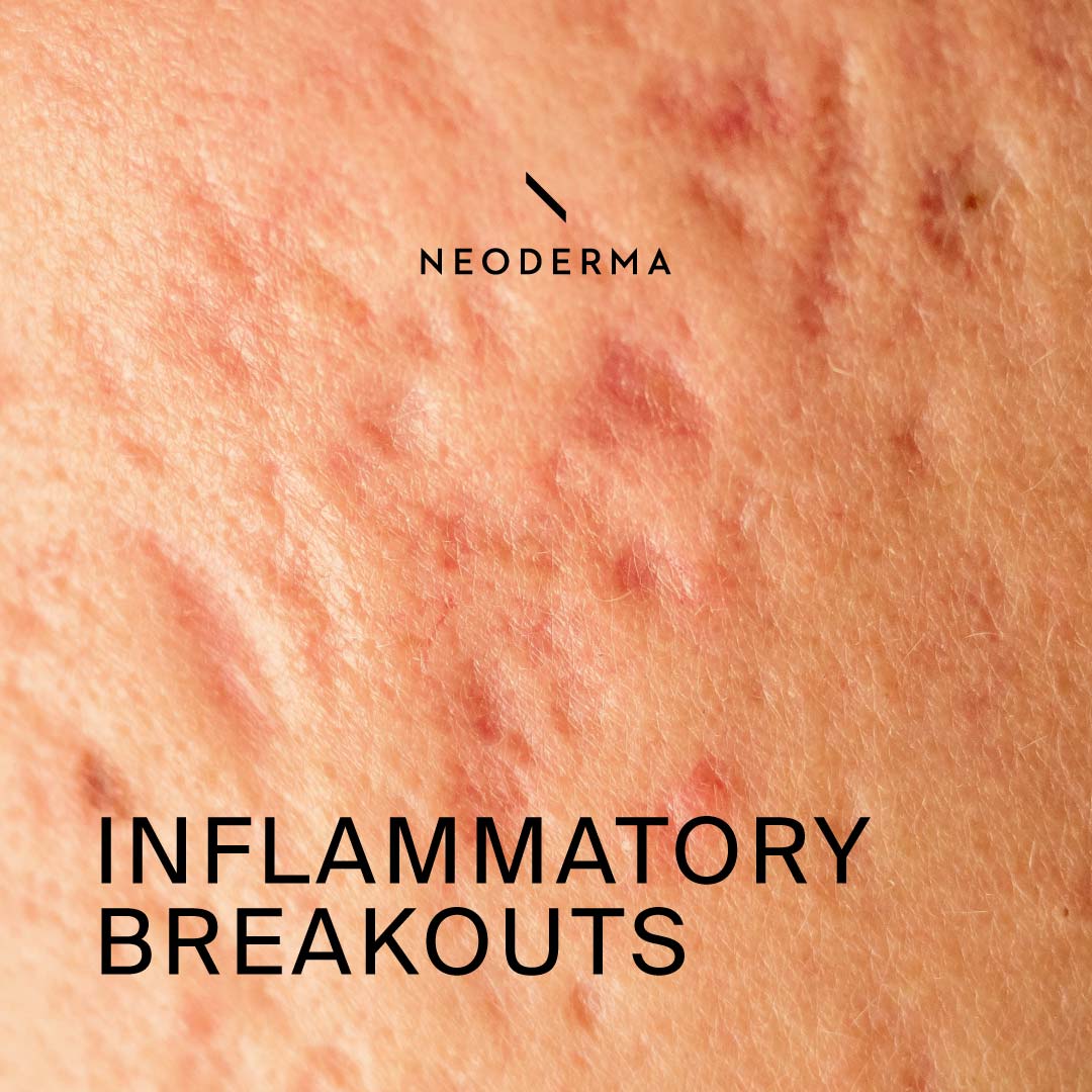 Inflammatory Breakouts