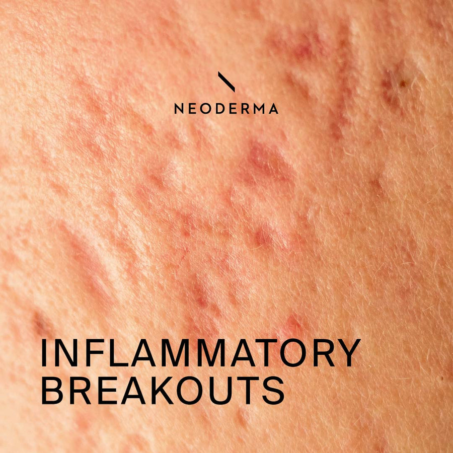 Inflammatory Breakouts
