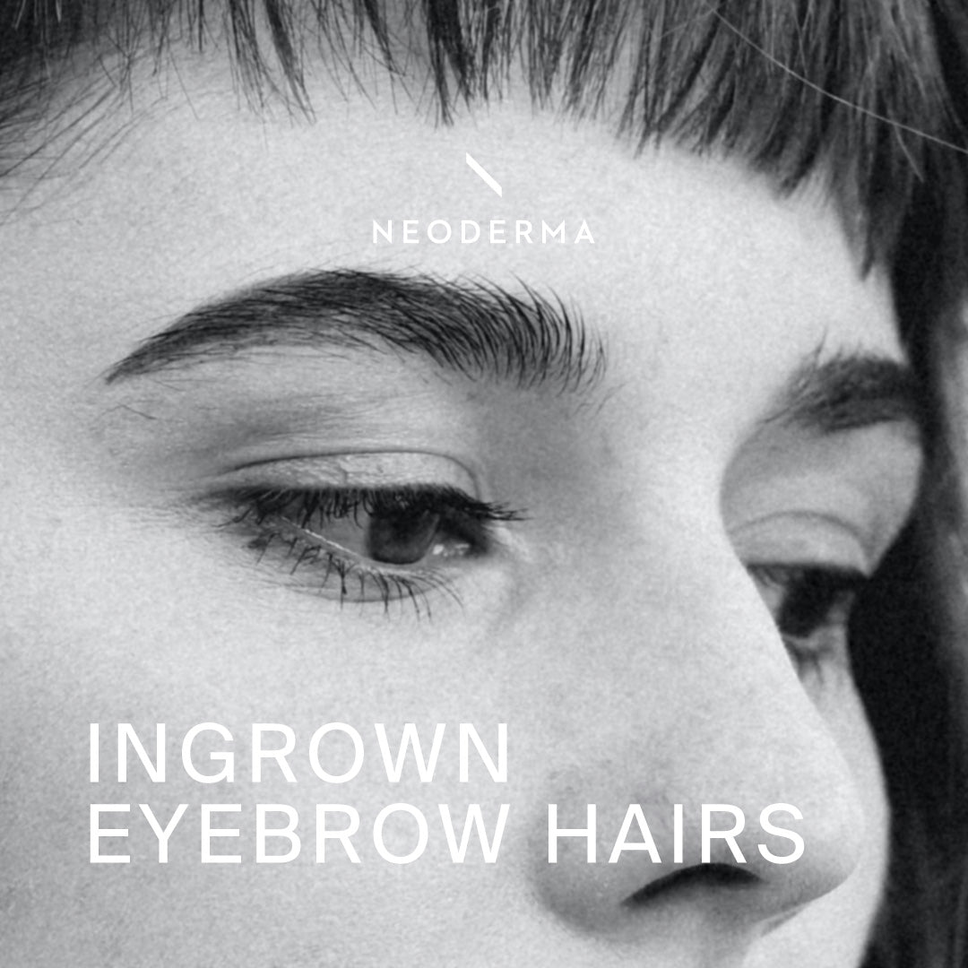 Ingrown Eyebrow Hairs