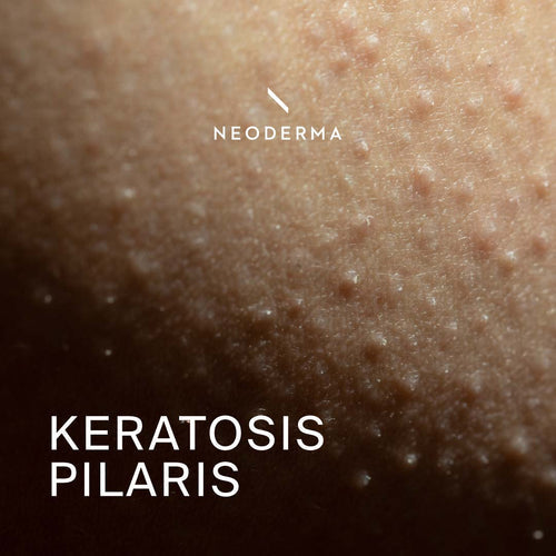 Keratosis Pilaris