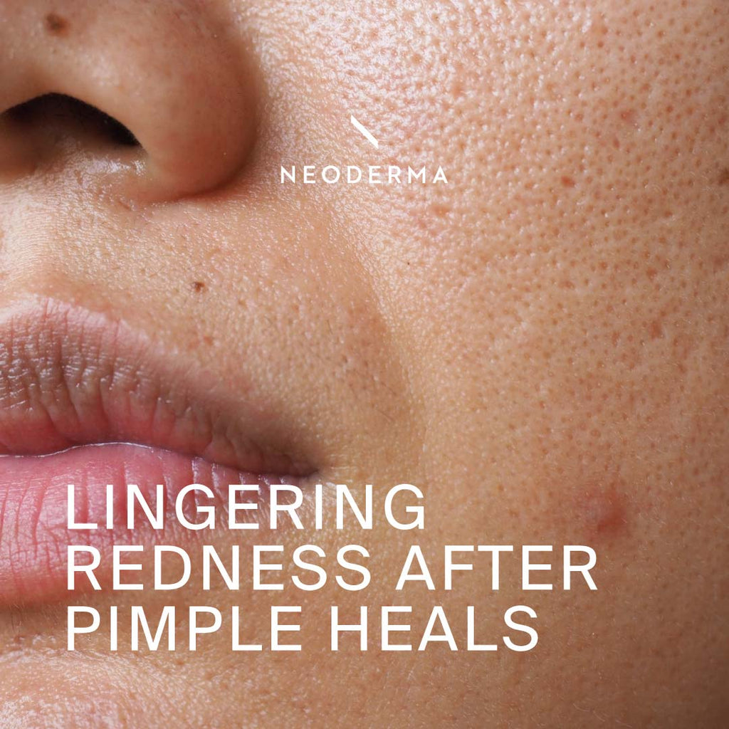 Lingering Redness After Pimple Heals