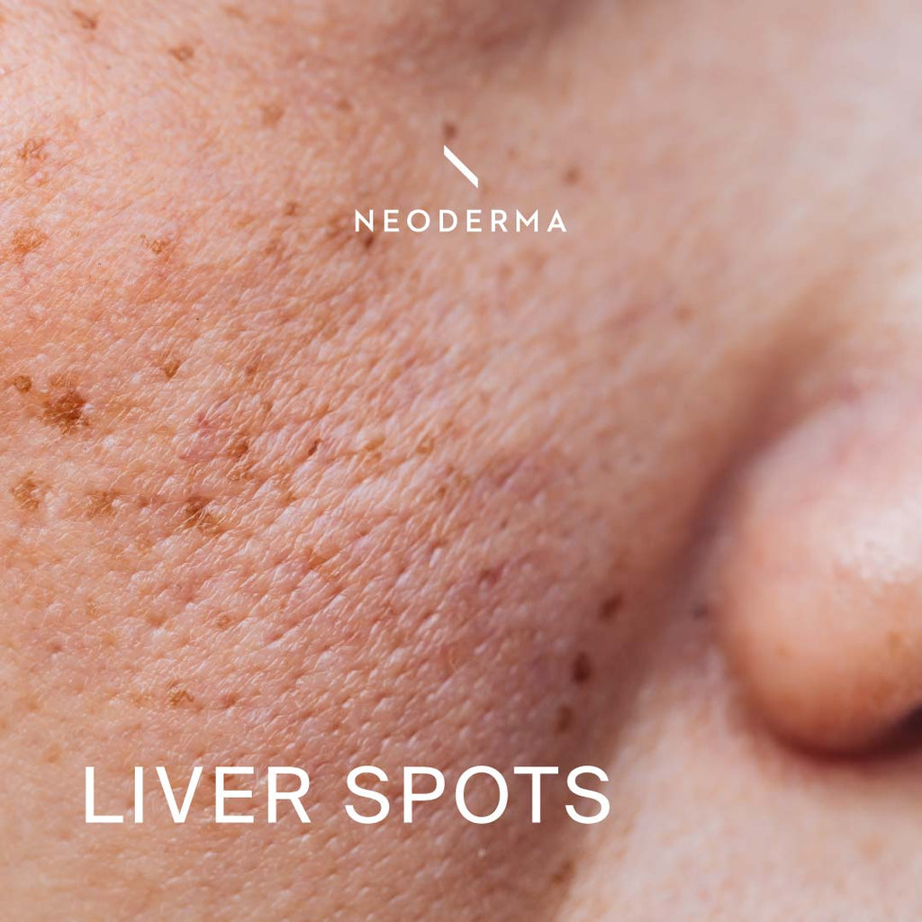 Liver Spots