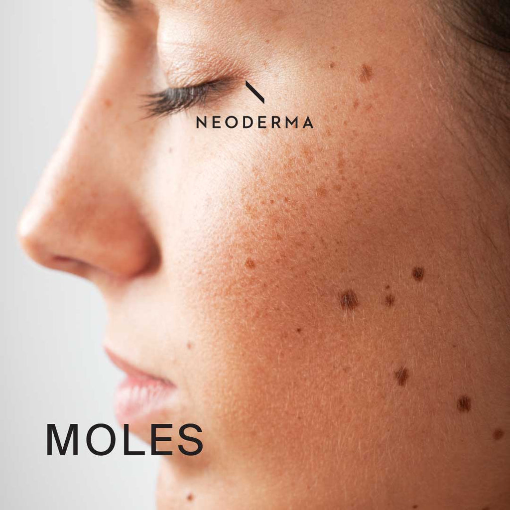 Moles