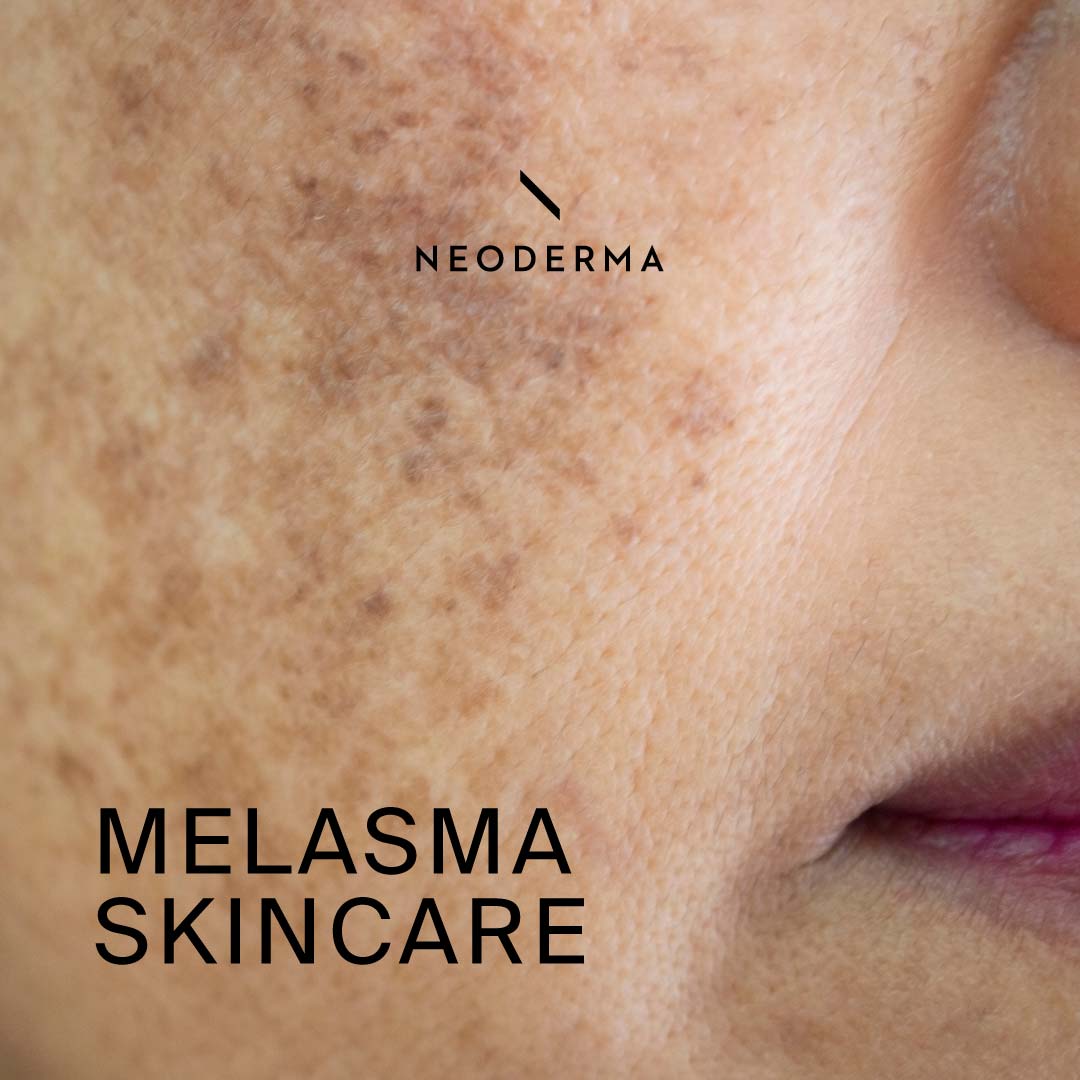 Melasma Skincare
