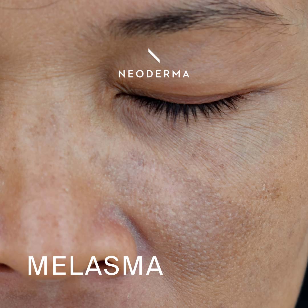 Melasma Neoderma 