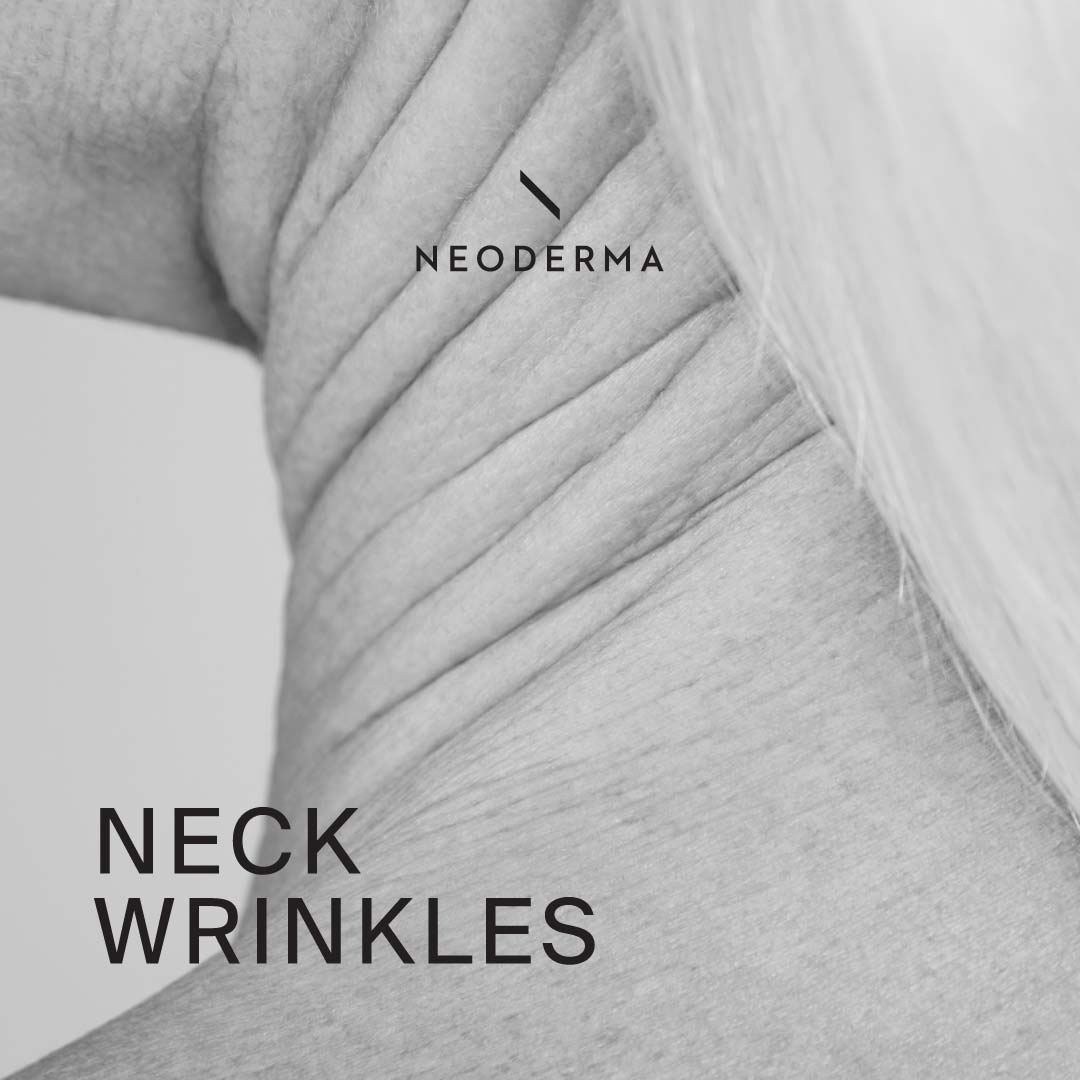 Neck Wrinkles