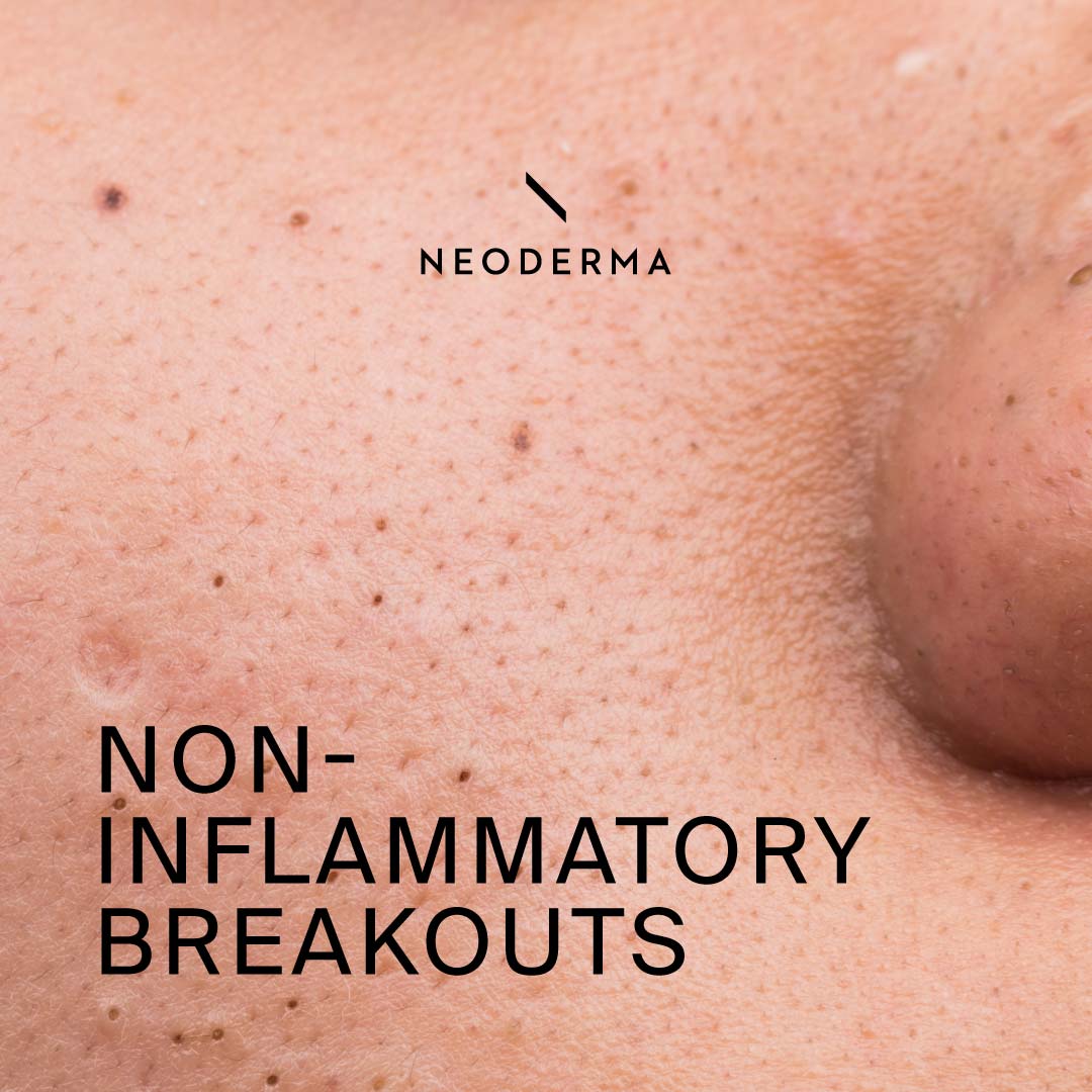 Non Inflammatory Breakouts