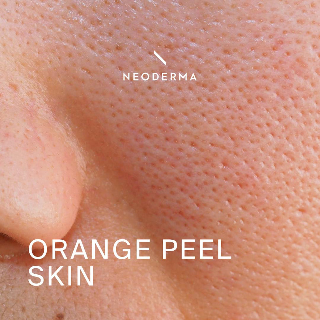 Orange Peel Skin