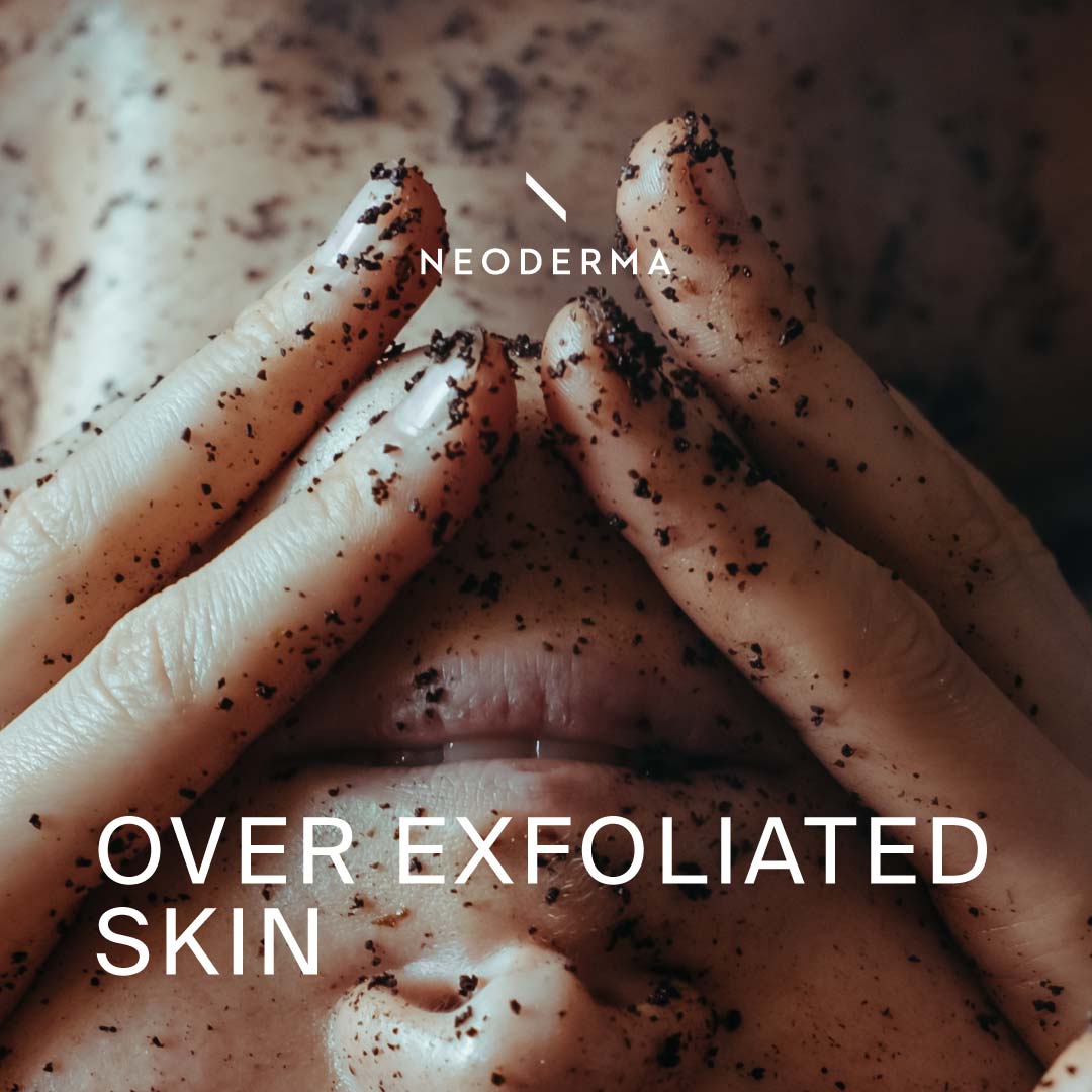 Over Exfoliated Skin