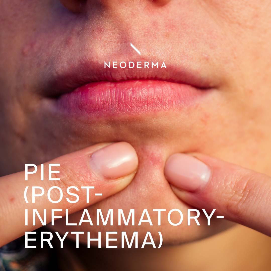 PIE (Post-Inflammatory-Erythema)