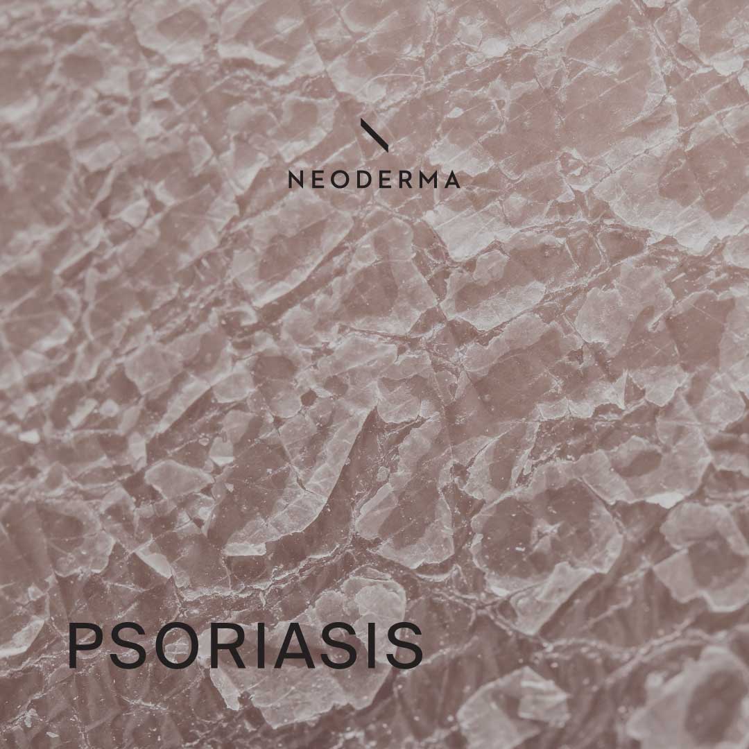 Psoriasis Skin Treatment | NEODERMA