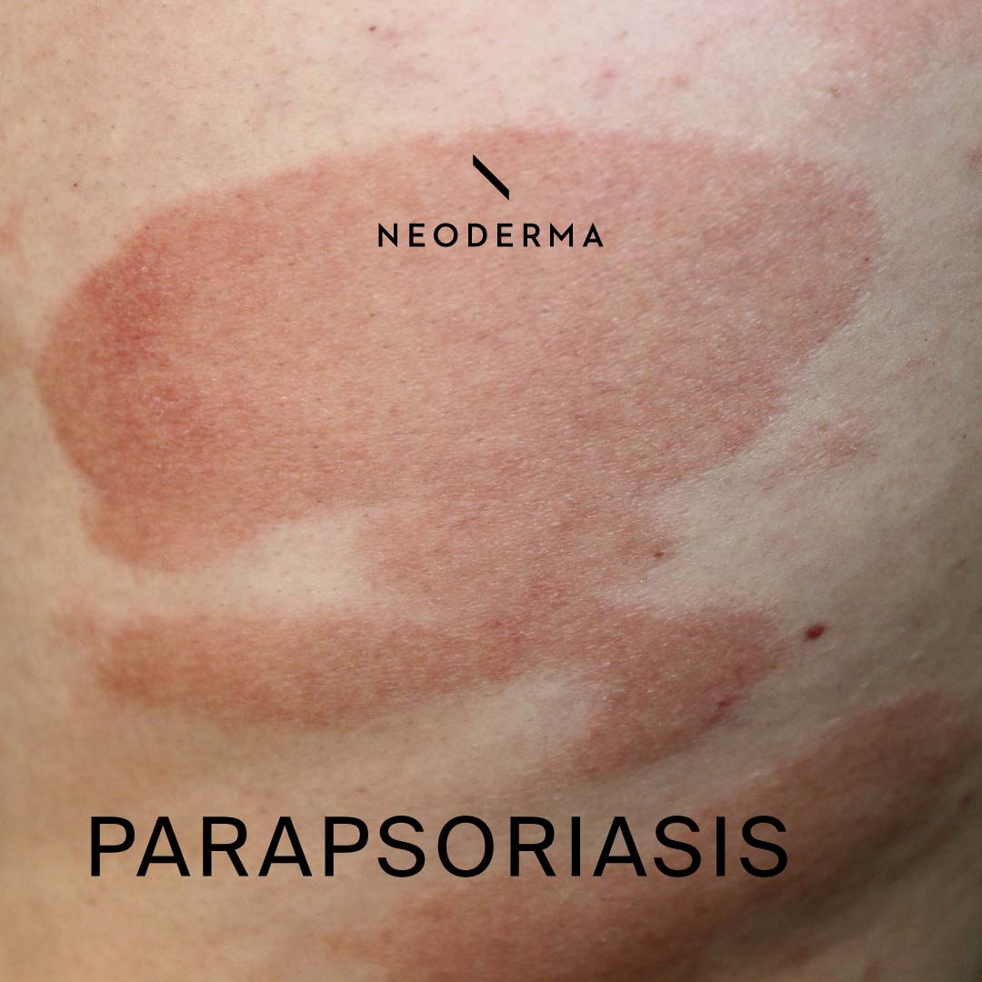 Parapsoriasis Symptoms | NEODERMA