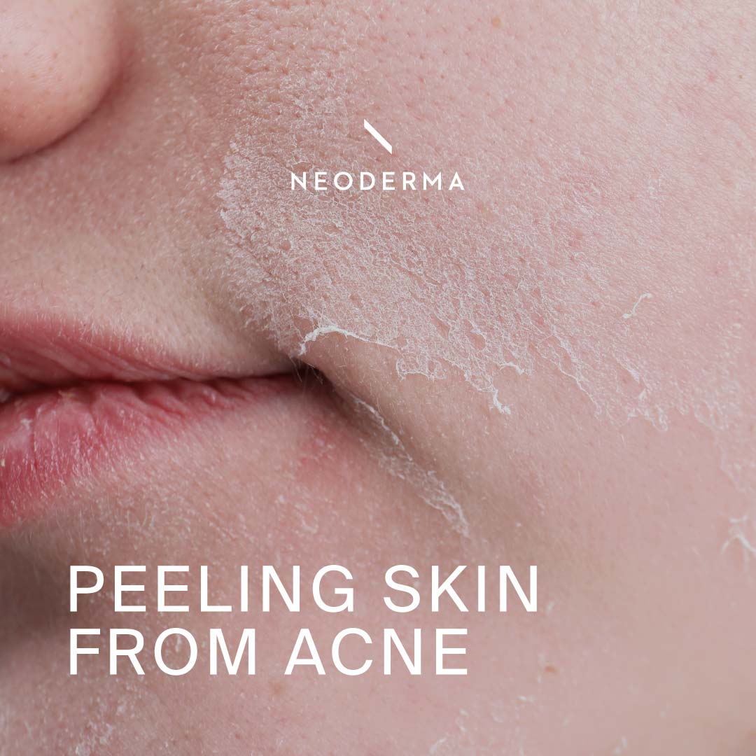 Peeling Skin From Acne