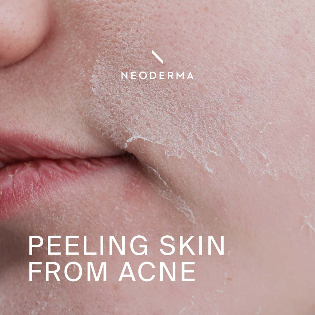 Peeling Skin From Acne