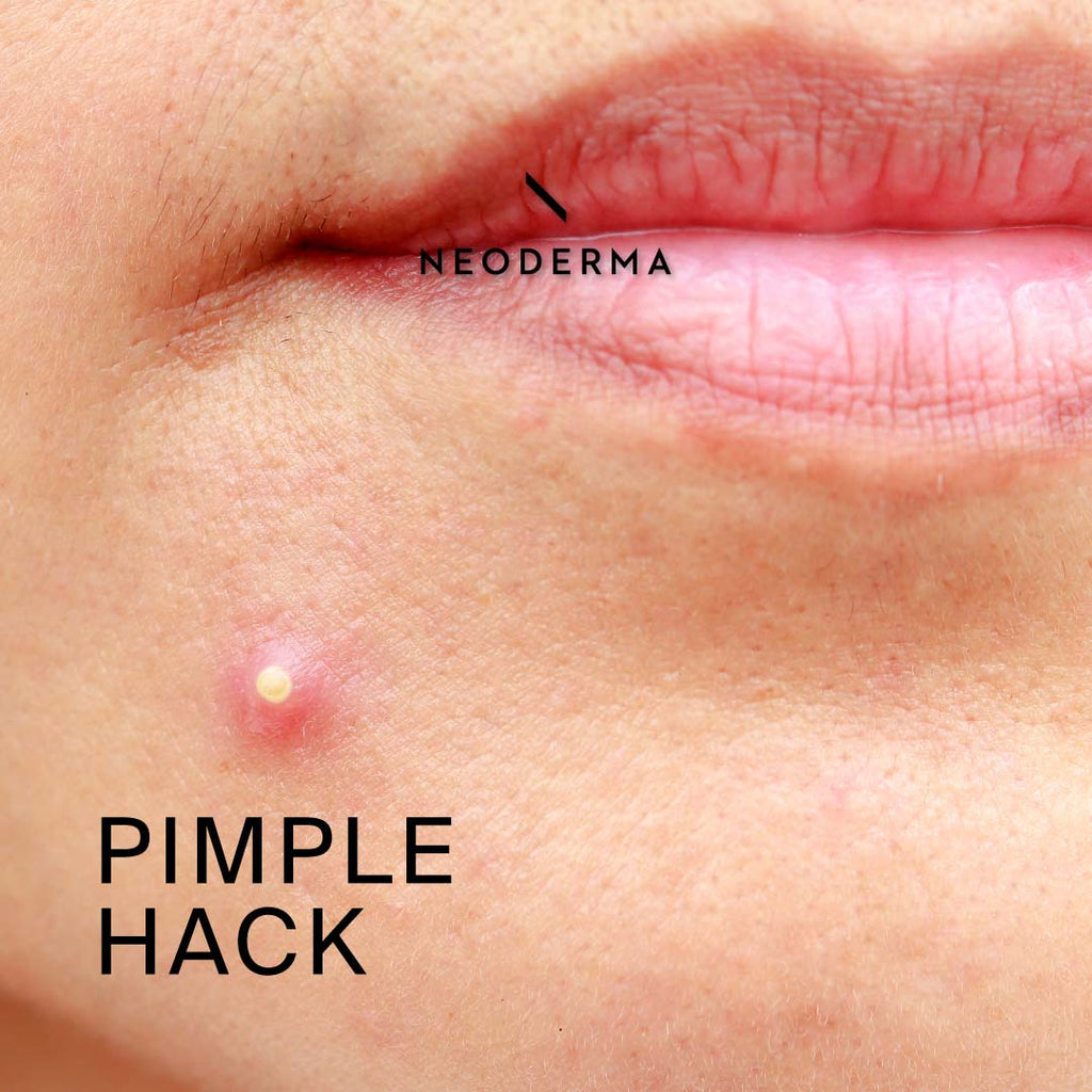 Pimple Hack