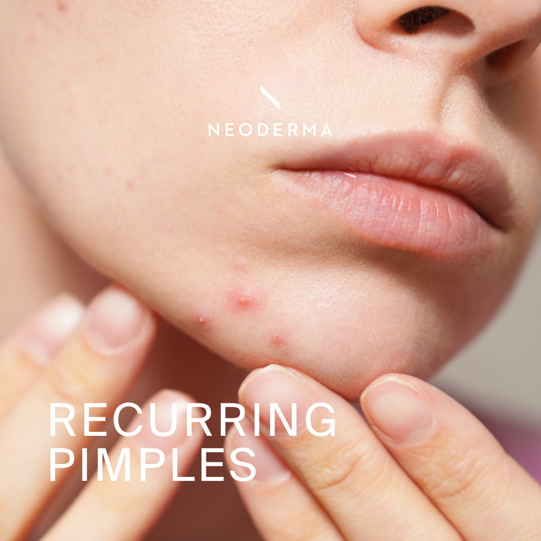 Recurring Pimples