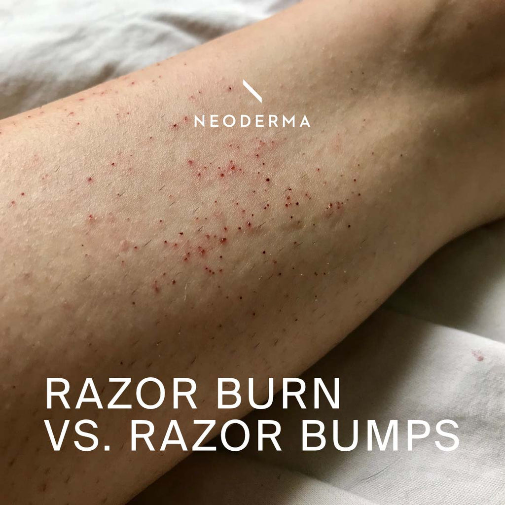 Razor Burn Vs. Razor Bumps