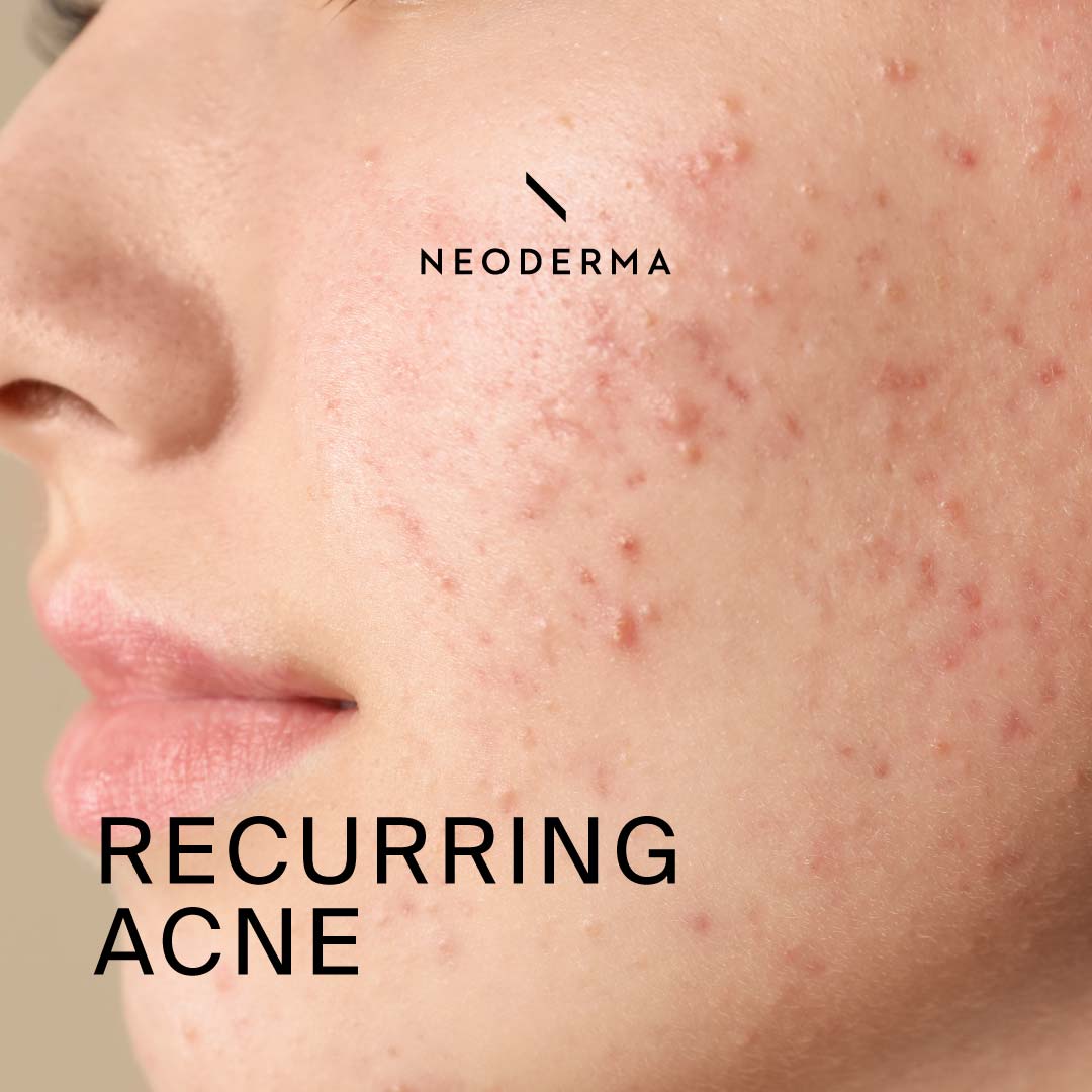 Stunning Causes Of Recurring Acne image