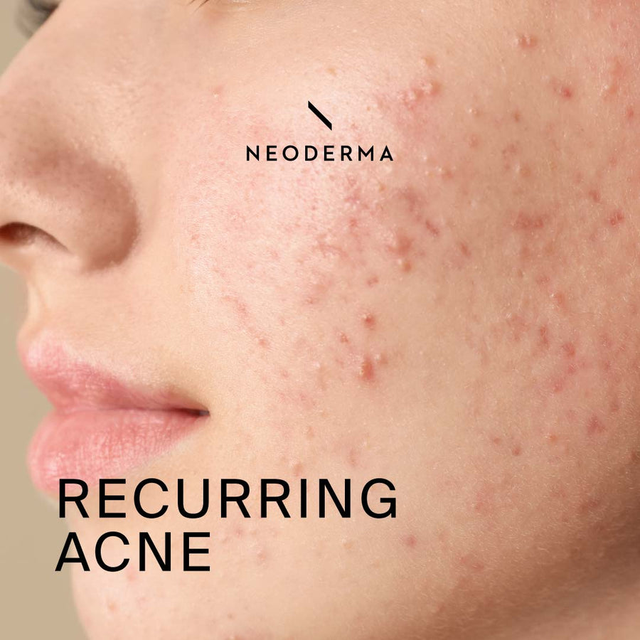 Recurring Acne
