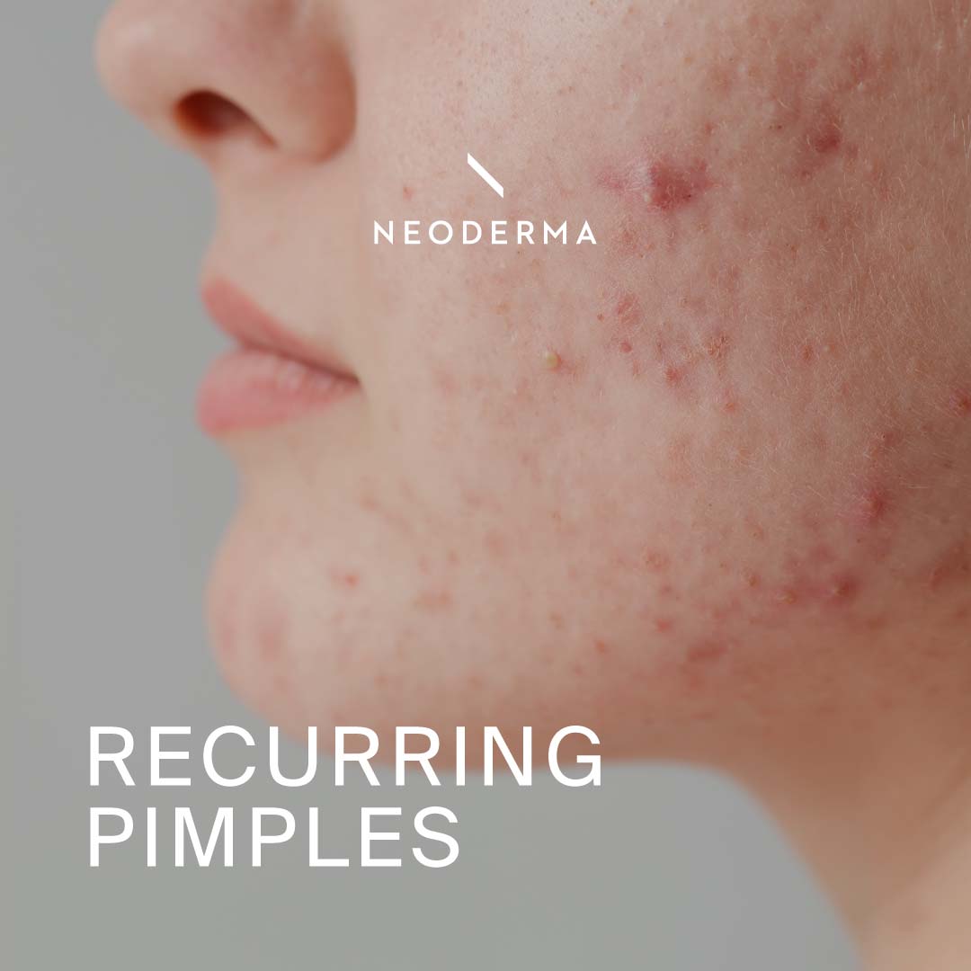 Recurring Pimples