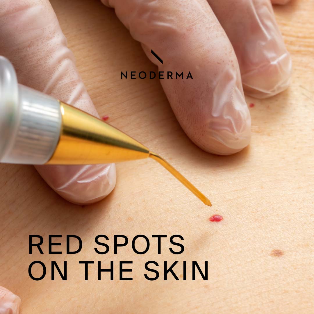 Red Spots on the Skin