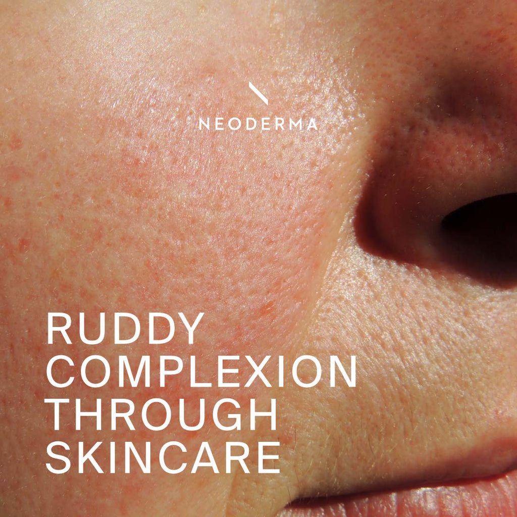 Ruddy Complexion Through Skincare