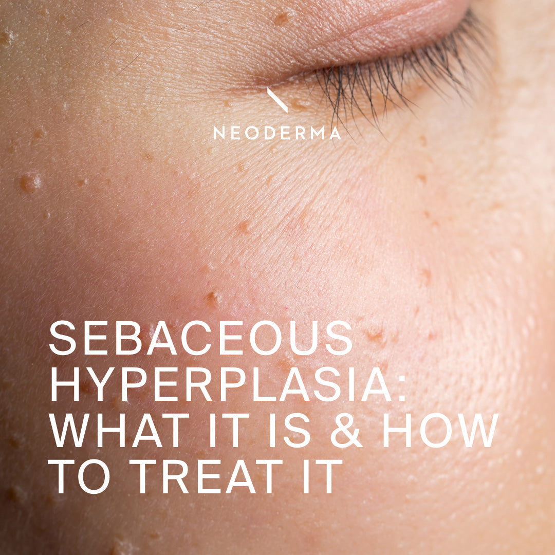 Sebaceous Hyperplasia: What It Is & How to Treat It
