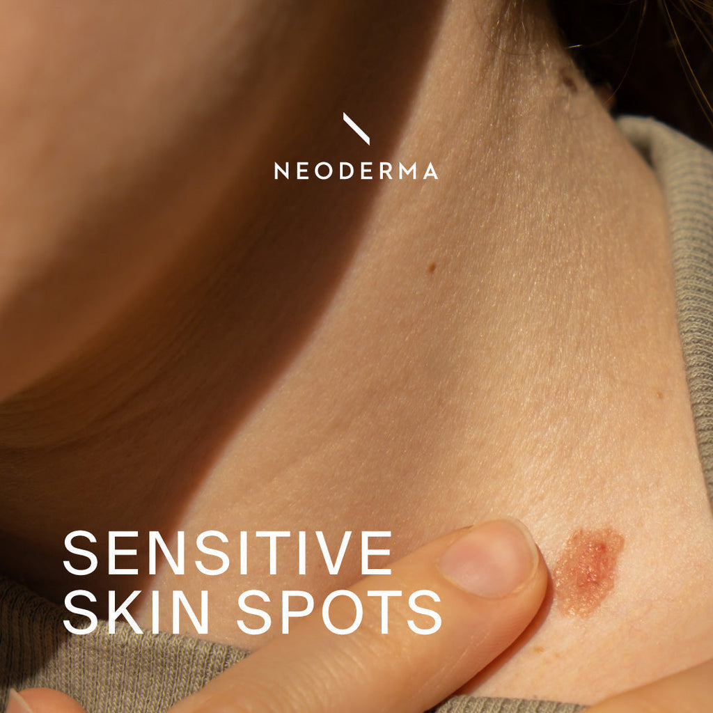 Sensitive Skin Spots
