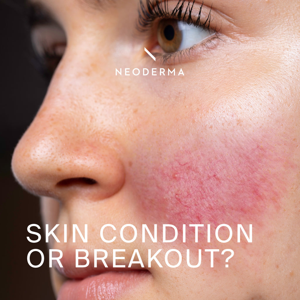Skin Conditions or Breakout?