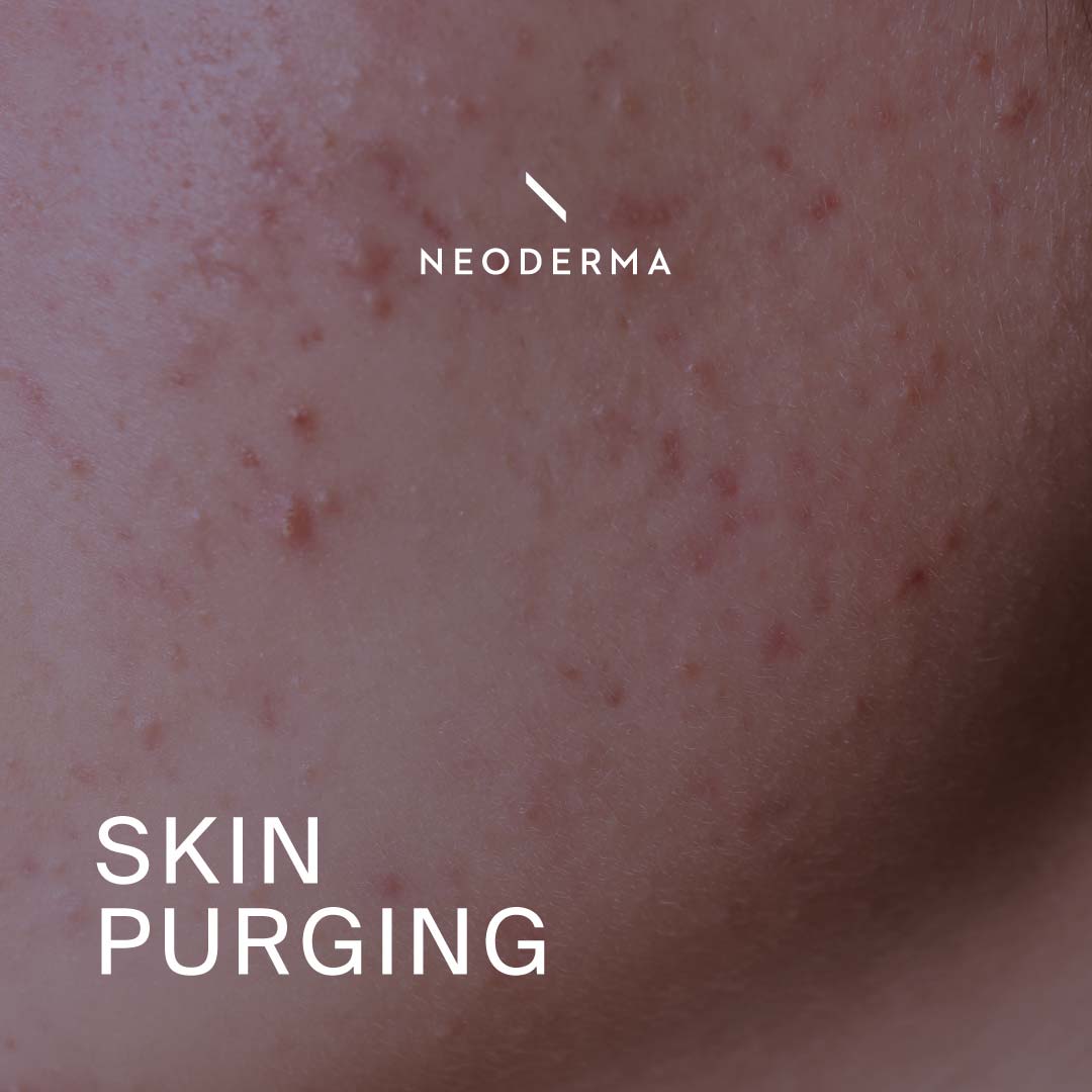 Skin Purging Reaction | NEODERMA