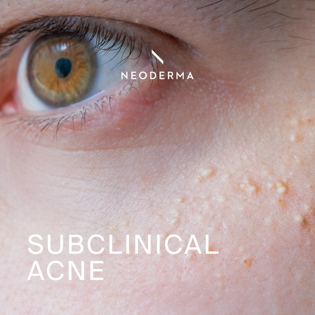 Subclinical Acne