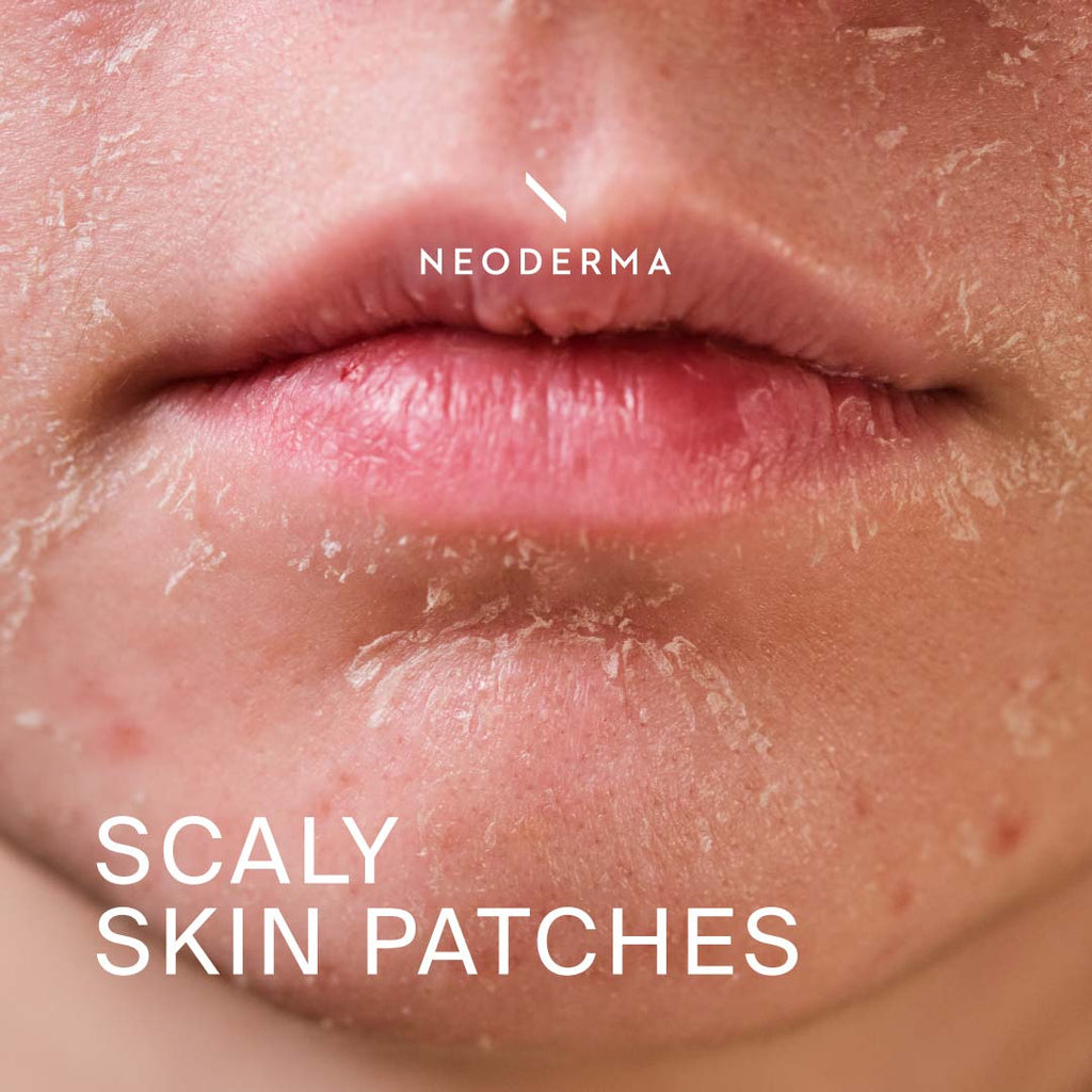 Scaly Skin Patches