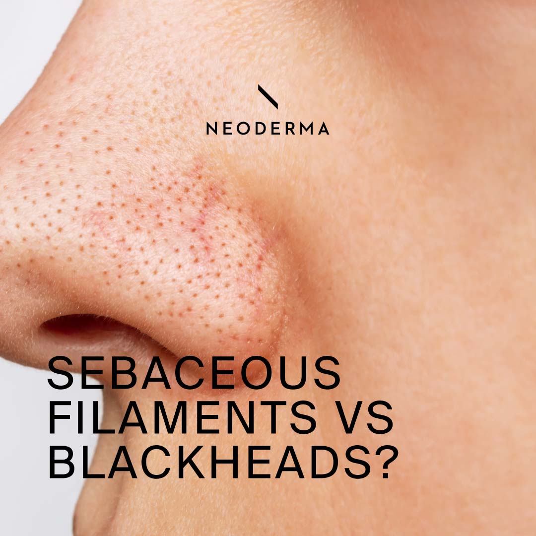 Sebaceous Filaments Vs Blackheads