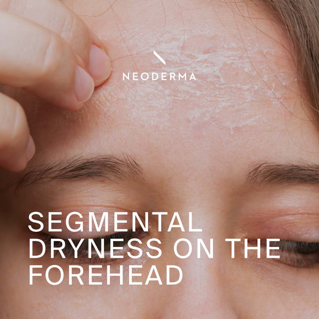 Segmental Dryness on the Forehead