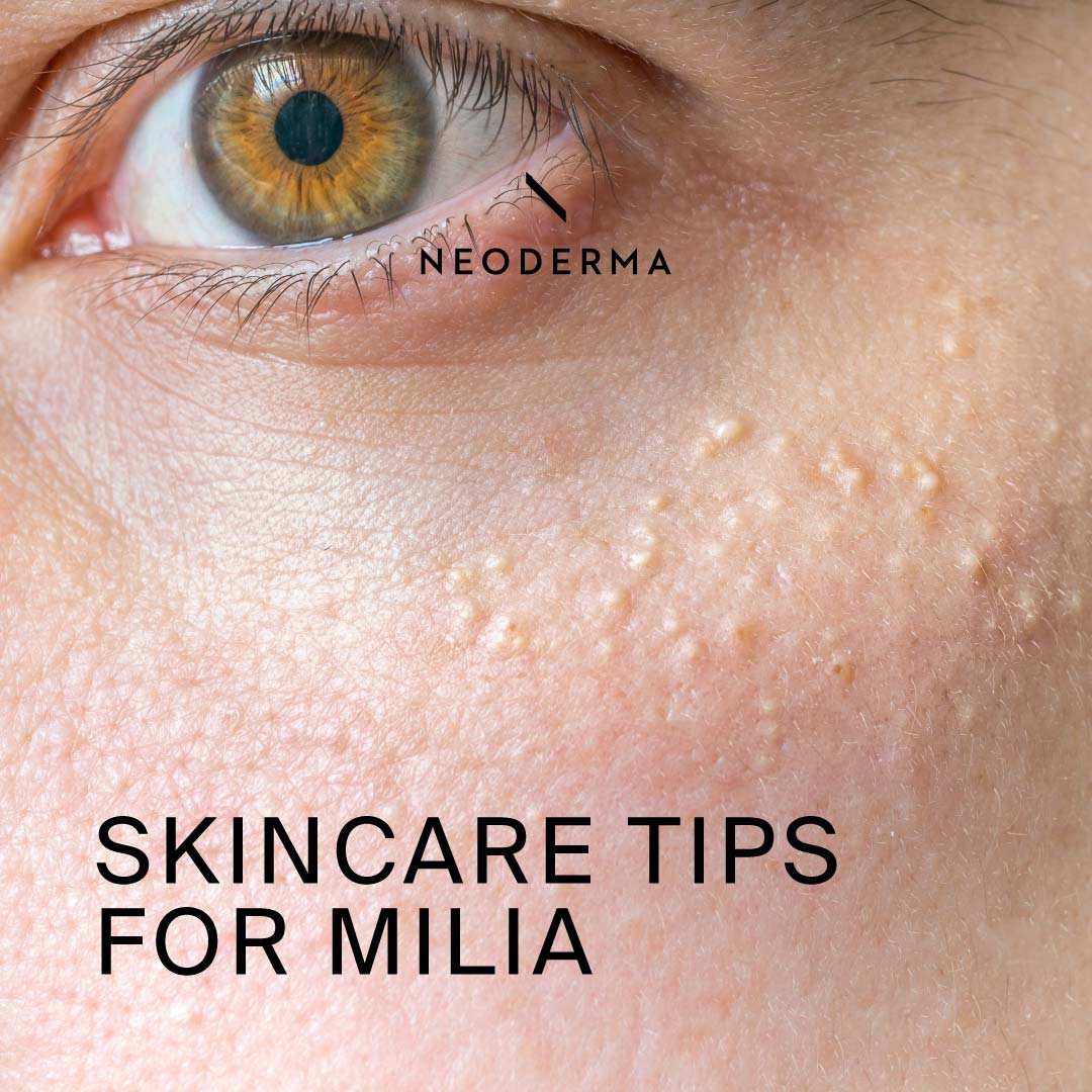 Skincare Tips for Milia