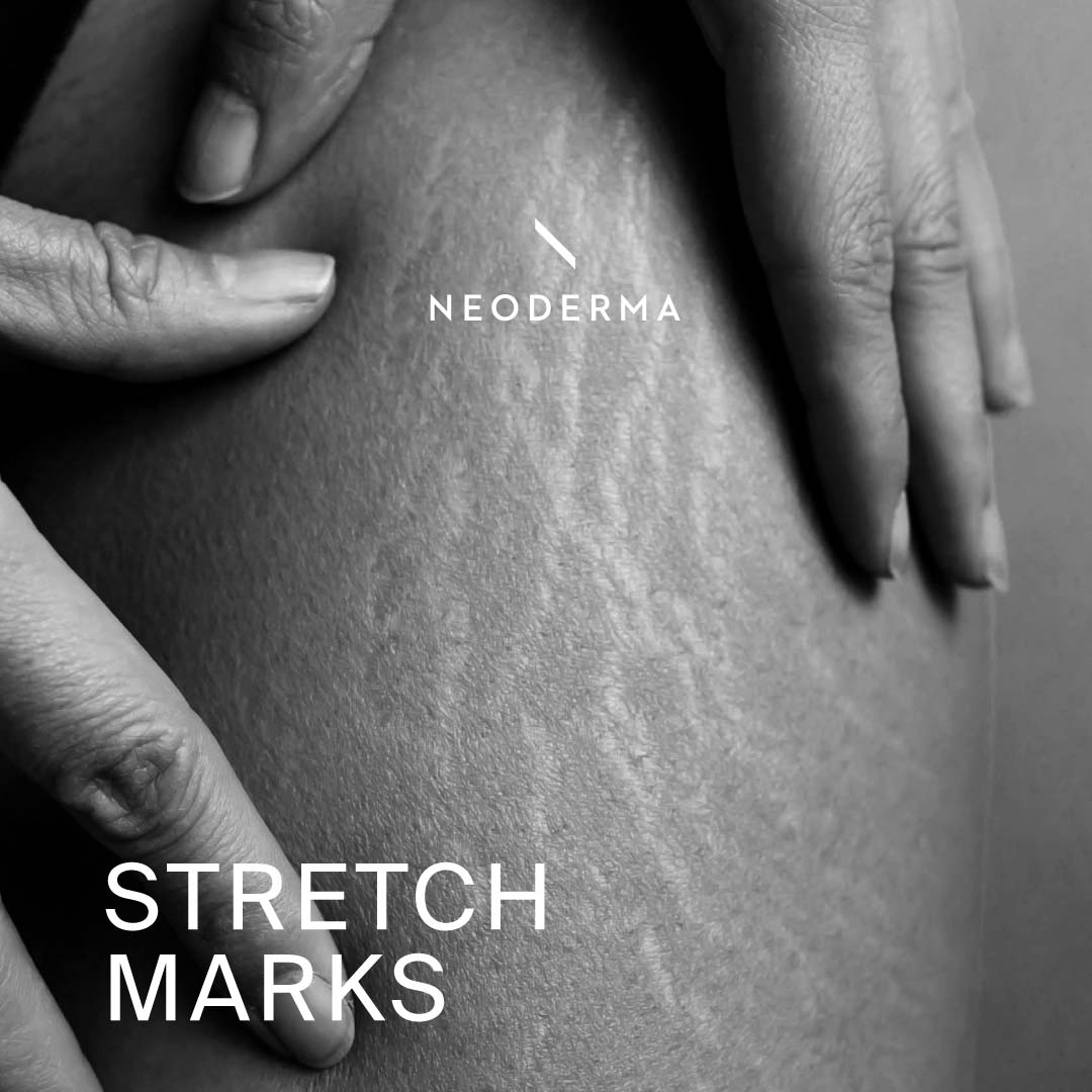 Stretch Marks