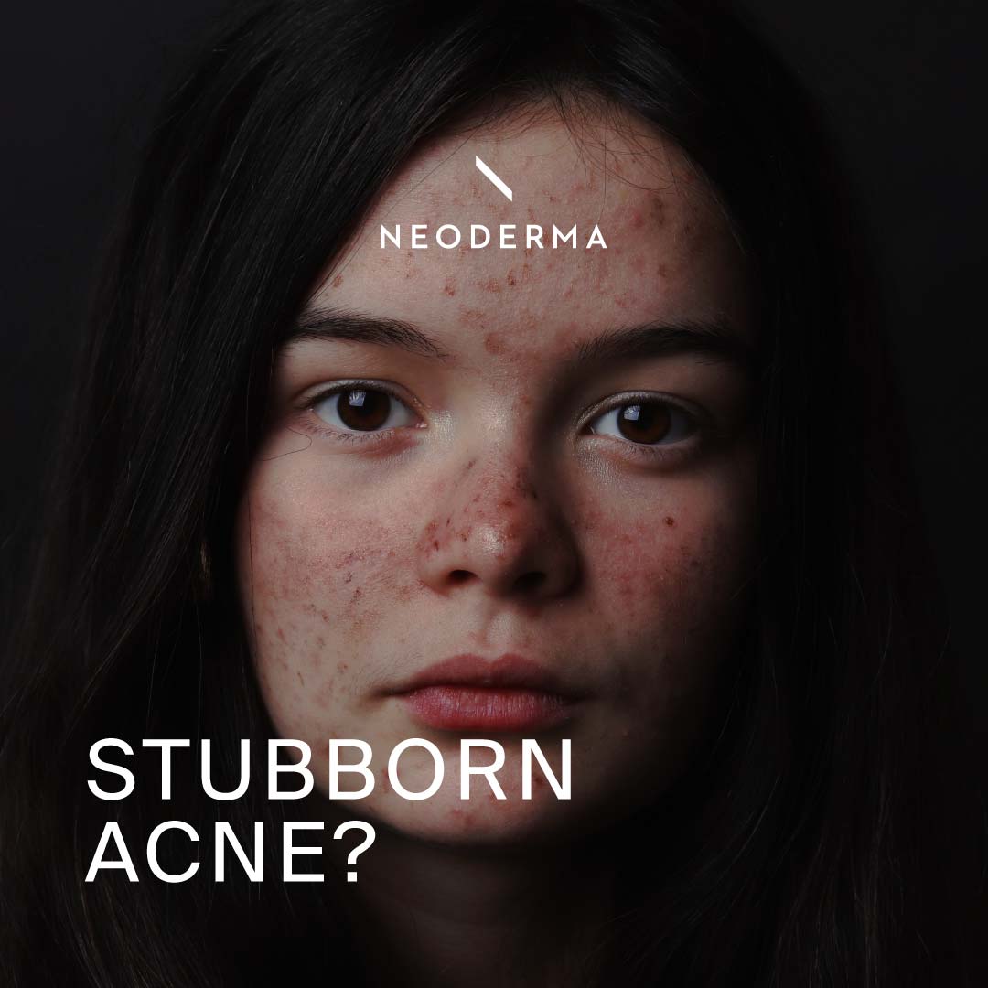 Stubborn Acne?