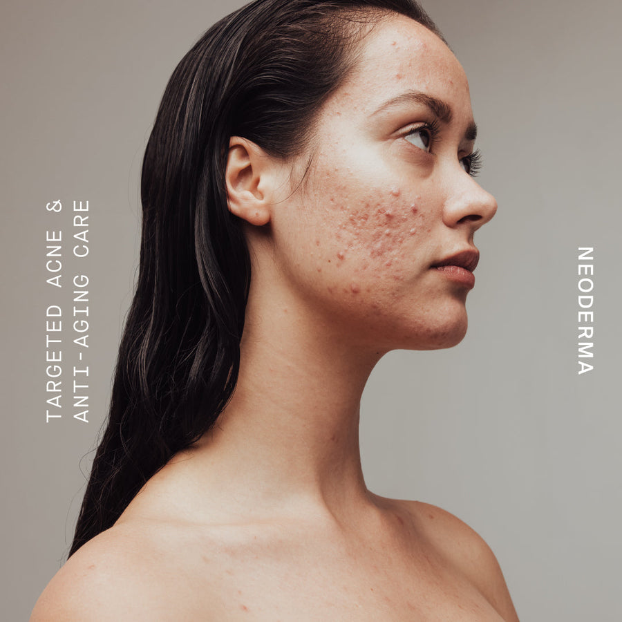 Acne Types: What Anti-Aging Anti-Blemish Skin Care Each Acne Type Needs