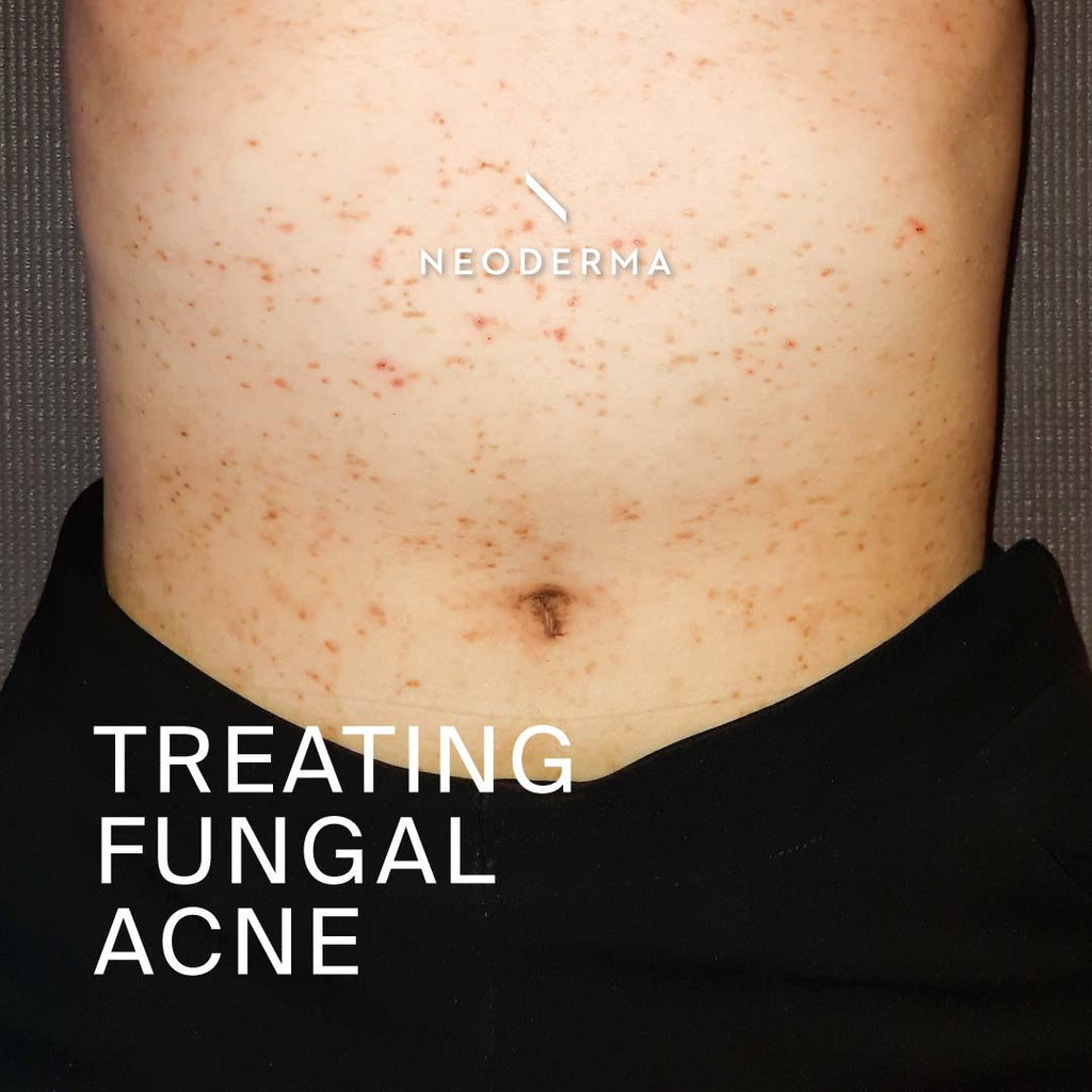 Treating Fungal Acne