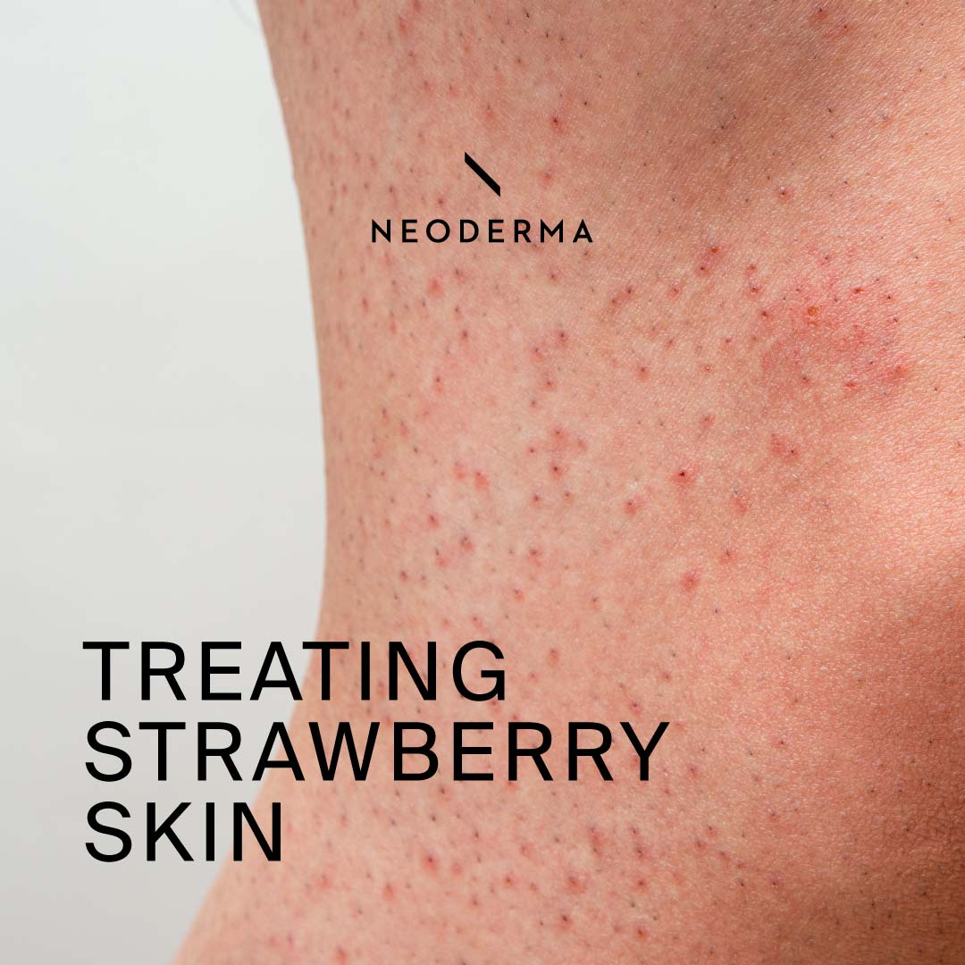 Treating Strawberry Skin